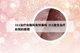 311治疗白癜风有效果吗 311激光治疗白斑的原理