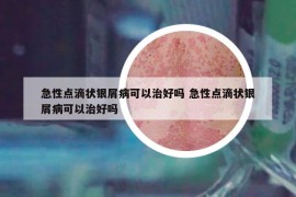 急性点滴状银屑病可以治好吗 急性点滴状银屑病可以治好吗