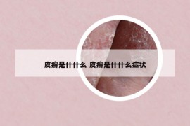 皮癣是什什么 皮癣是什什么症状