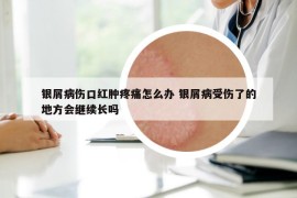 银屑病伤口红肿疼痛怎么办 银屑病受伤了的地方会继续长吗