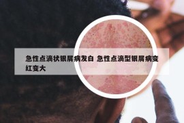 急性点滴状银屑病发白 急性点滴型银屑病变红变大