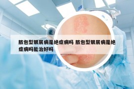 脓包型银屑病是绝症病吗 脓包型银屑病是绝症病吗能治好吗