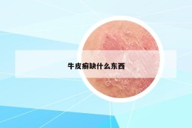 牛皮癣缺什么东西