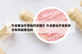 牛皮廨治疗用啥药膏图片 牛皮廨治疗目前有没有彻底根治的