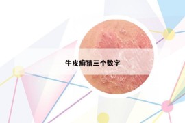 牛皮癣猜三个数字