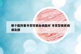 那个医院看寻常性银血病最好 寻常型银屑病病友群