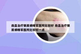 南昌治疗银屑病哪家医院比较好 南昌治疗银屑病哪家医院比较好一点