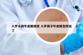 八岁小孩牛皮癣症状 八岁孩子牛皮鲜怎样治了