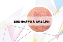 怎样控制皮癣不复发 皮癣怎么预防