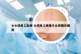 小小孩身上起癣 小孩身上癣是什么样图片图库