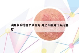 满身长癣擦什么药膏好 身上长癣用什么药治疗