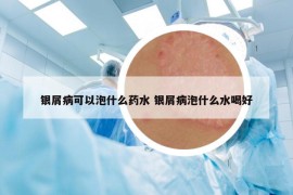 银屑病可以泡什么药水 银屑病泡什么水喝好