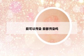 藓可以传染 藓都传染吗