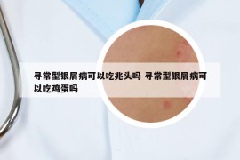 寻常型银屑病可以吃兆头吗 寻常型银屑病可以吃鸡蛋吗