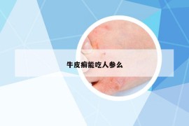 牛皮癣能吃人参么