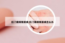 肛门瘙痒银屑病 肛门瘙痒银屑病怎么办