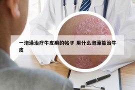 一泡澡治疗牛皮癣的帖子 用什么泡澡能治牛皮