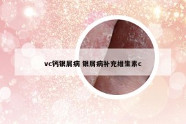 vc钙银屑病 银屑病补充维生素c