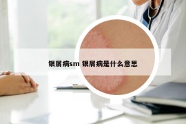 银屑病sm 银屑病是什么意思