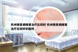 杭州银屑病哪里治疗比较好 杭州银屑病哪里治疗比较好的医院