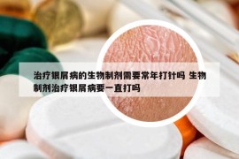 治疗银屑病的生物制剂需要常年打针吗 生物制剂治疗银屑病要一直打吗