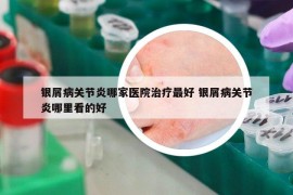 银屑病关节炎哪家医院治疗最好 银屑病关节炎哪里看的好