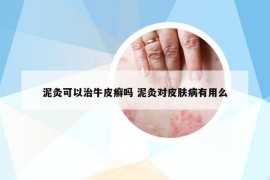 泥灸可以治牛皮癣吗 泥灸对皮肤病有用么