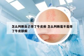 怎么判断自己得了牛皮癣 怎么判断是不是得了牛皮肤癣