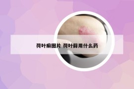 荷叶癣图片 荷叶藓用什么药