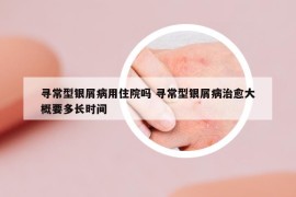 寻常型银屑病用住院吗 寻常型银屑病治愈大概要多长时间