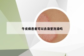 牛皮癣患者可以去澡堂洗澡吗