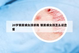 20岁银屑病女孩求助 银屑病女孩怎么谈恋爱