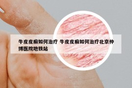 牛皮皮癣如何治疗 牛皮皮癣如何治疗北京仲博医院地铁站