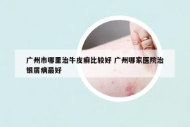 广州市哪里治牛皮癣比较好 广州哪家医院治银屑病最好