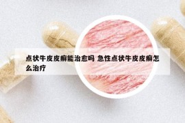 点状牛皮皮癣能治愈吗 急性点状牛皮皮癣怎么治疗