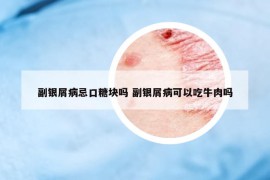 副银屑病忌口糖块吗 副银屑病可以吃牛肉吗