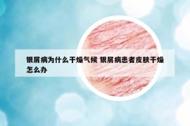 银屑病为什么干燥气候 银屑病患者皮肤干燥怎么办