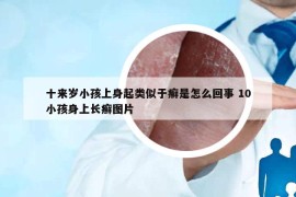 十来岁小孩上身起类似于癣是怎么回事 10小孩身上长癣图片