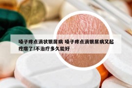 嗓子疼点滴状银屑病 嗓子疼点滴银屑病又起疙瘩了!不治疗多久能好