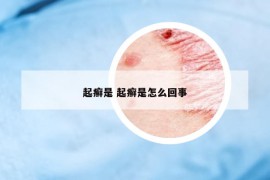 起癣是 起癣是怎么回事