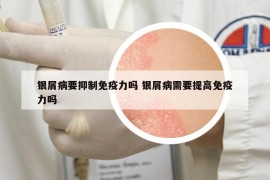 银屑病要抑制免疫力吗 银屑病需要提高免疫力吗