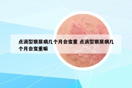 点滴型银屑病几个月会变重 点滴型银屑病几个月会变重嘛