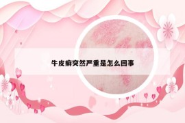 牛皮癣突然严重是怎么回事