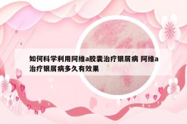 如何科学利用阿维a胶囊治疗银屑病 阿维a治疗银屑病多久有效果