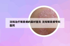 沈阳治疗银屑病的最好医生 沈阳银屑病专科医院