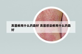 真菌癣用什么药最好 真菌感染癣用什么药最好