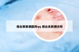 烟台银屑病医院qq 烟台皮肤病诊所