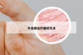 牛皮癣治疗最好方法