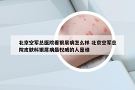 北京空军总医院看银屑病怎么样 北京空军总院皮肤科银屑病最权威的人是谁