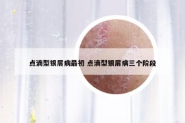 点滴型银屑病最初 点滴型银屑病三个阶段